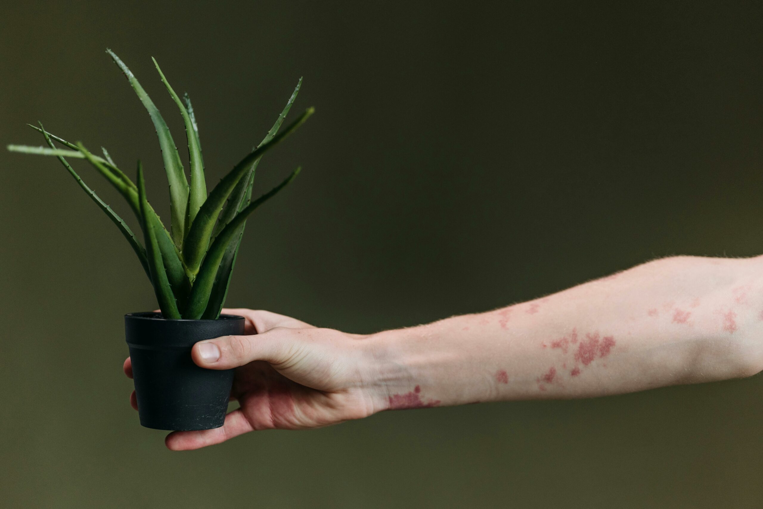 Comment traiter l'eczéma